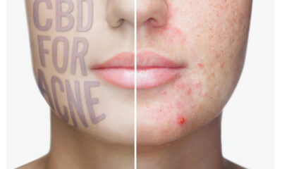 CBD Acne