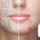 CBD Acne