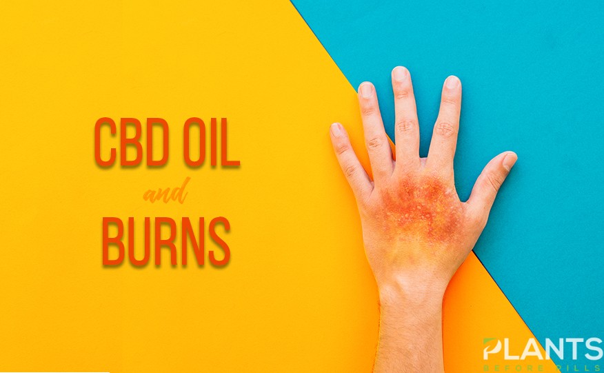 CBD for Burns