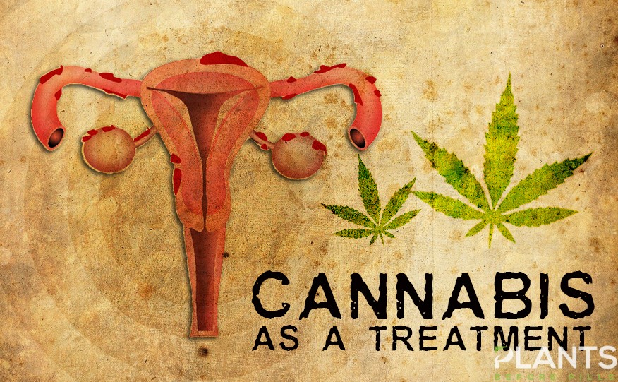 Cannabis as a Treatment for Endometriosis