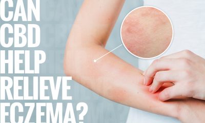 Can CBD Help Relieve Eczema