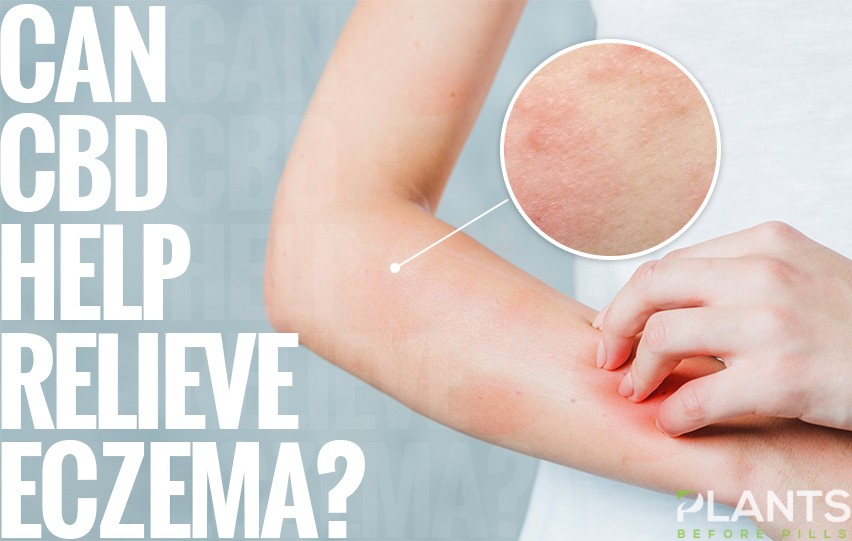 Can CBD Help Relieve Eczema