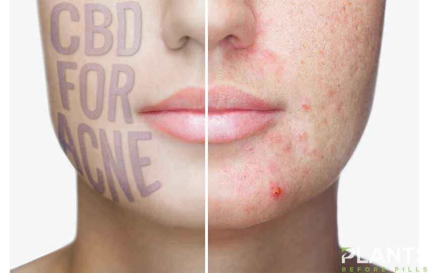 CBD Acne