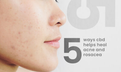 CBD HELPS HEAL ACNE AND ROSACEA