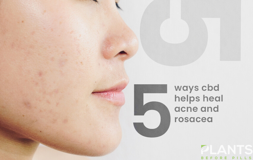 CBD HELPS HEAL ACNE AND ROSACEA