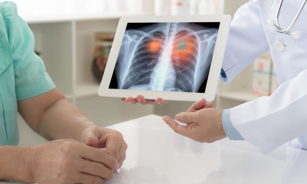 CBD for Lung Cancer